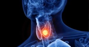 Tiroidite di Hashimoto e tiroidite subacuta.