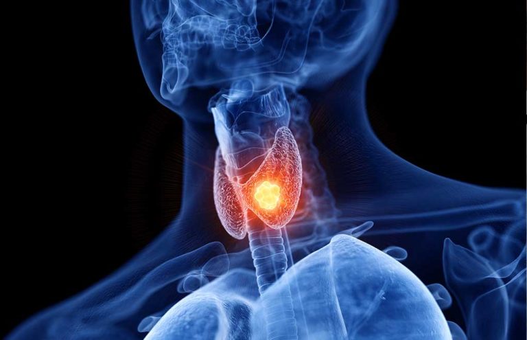 Tiroidite di Hashimoto e tiroidite subacuta.
