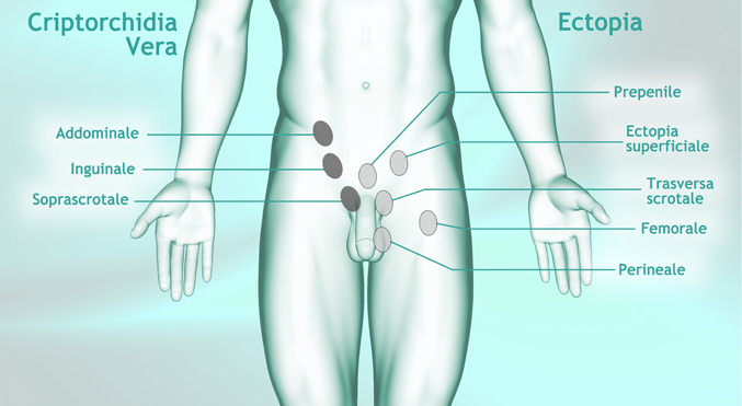 Preservare la Fertilità: curare il criptorchidismo