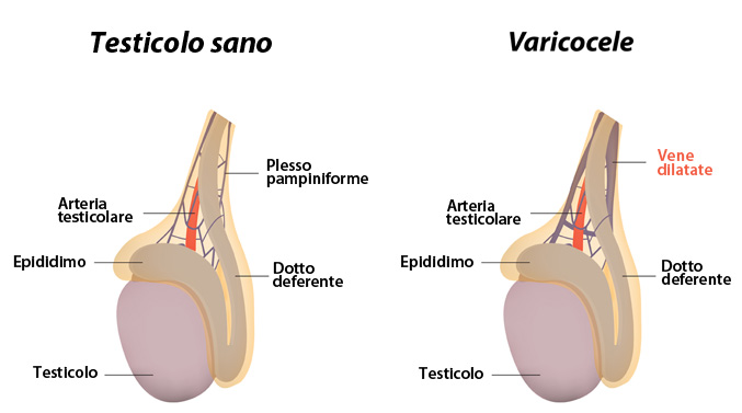 Varicocele nell’adolescente: rischio di infertilità in età adulta