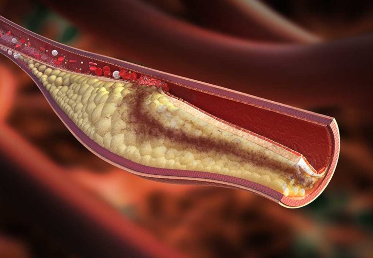 L’ipertrigliceridemia come fattore di rischio: un nemico dimenticato?