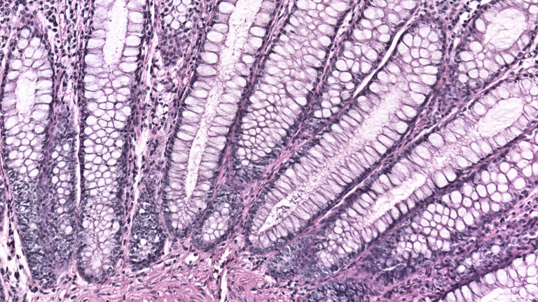 Radioterapia pelvica e cistite: quale trattamento?