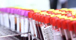 Esami del sangue per diagnosticare le patologie della tiroide: tsh test e successivi approfondimenti.